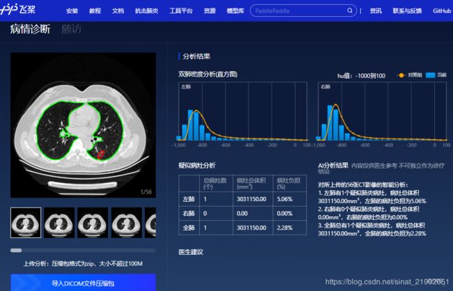 肺炎检测